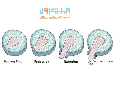 انواع پارگی دیسک کمر شامل فتق دیسک و اکستروژن دیسک می‌شود که در هر دو مورد دیسک از جایگاه طبیعی خود خارج می‌شود.