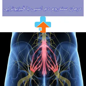 سندروم دم اسبی یک اختلال عصبی است که درمان آن با فیزیوتراپی می‌تواند به بهبود عملکرد حرکتی و کاهش علائم بیمار کمک کند.