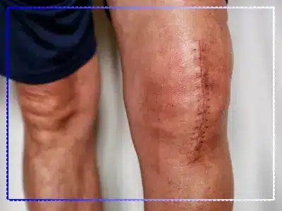 عوارض تعویض مفصل زانو ممکن است شامل عفونت، لخته شدن خون و کاهش دامنه حرکت مفصل باشد.