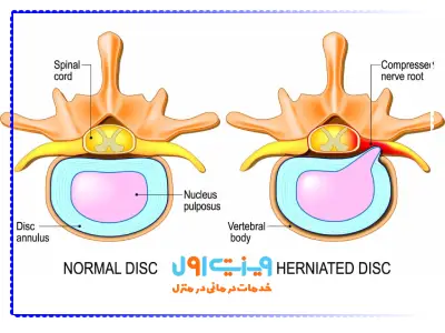دیسکهای بین مهرهای (Intervertebral discs) بهعنوان بالشتکهایی عمل میکنند که فشار و ضربات وارد بر ستون فقرات را جذب کرده و توزیع میکنند.