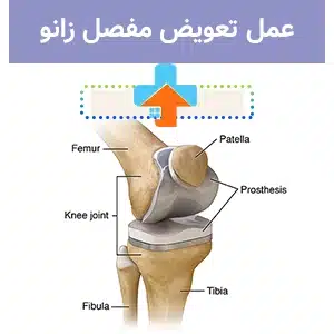 مراقبت بعد از عمل تعویض مفصل زانو با فیزیوتراپی مناسب، به تسریع روند بهبودی و بهبود حرکت زانو کمک می‌کند.
