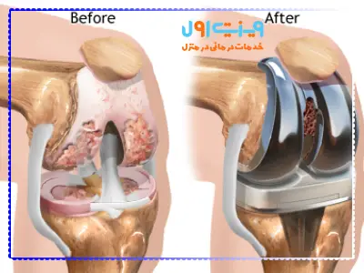 تعویض مفصل زانو به کاهش درد و بازگرداندن دامنه حرکت زانو کمک کرده و سلامت استخوان و غضروف را بهبود می‌بخشد.