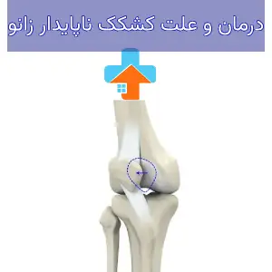 کشکک ناپایدار زانو می‌تواند از جمله علت‌های اصلی زانوی ناپایدار باشد که نیاز به بررسی دقیق دارد.