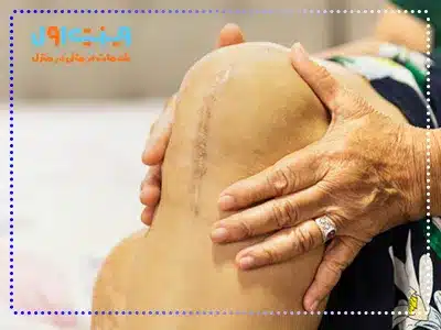 علائم خشکی زانو پس از تعویض مفصل معمولاً شامل درد شدید، کاهش دامنه حرکتی و احساس سفتی در مفصل زانو است.