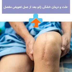 خشکی زانو بعد از عمل تعویض مفصل یکی از مشکلات شایعی است که با برنامه‌های توانبخشی مناسب می‌توان به بهبود سریع‌تر آن پس از جراحی کمک کرد.