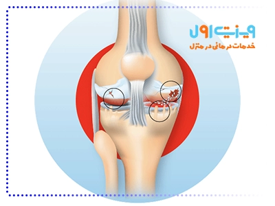 عوارض آرتروز زانو میتواند شامل درد مداوم، کاهش دامنه حرکتی و حتی تخریب تدریجی مفصل باشد.