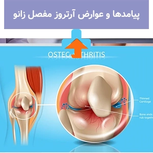 خطر آرتروز زانو در صورت عدم درمان به موقع، می‌تواند به کاهش انعطاف‌پذیری مفصل و ناتوانی حرکتی منجر شود.