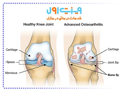 این بیماری معمولاً با درد مزمن، تورم، کاهش انعطافپذیری و صدای سایش در حین حرکت همراه است.