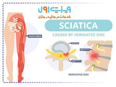 علائم دیسک کمر در پاها معمولاً با درد در باسن شروع شده و می‌تواند تا ساق و کف پا گسترش یابد.