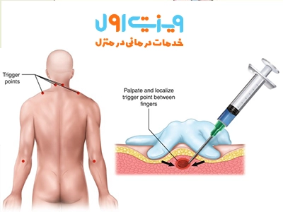 نحوه درمان سندرم درد میوفاسیال ممکن است شامل تزریق آمپول ضد التهاب برای کاهش التهاب و تسکین درد عضلانی باشد.