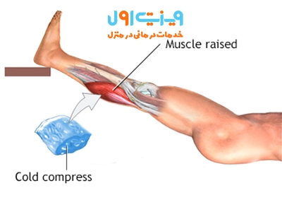 برای درمان کشیدگی عضله، استفاده از یخ و کمپرس کردن در مراحل اولیه و انجام فیزیوتراپی و ماساژ در مراحل بعدی، به بهبود سریع‌تر کمک می‌کند.