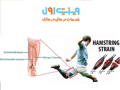 علت کشیدگی عضله ران یا چهار سر ران معمولاً به دلیل حرکت ناگهانی یا کشش بیش از حد عضلات در هنگام فعالیت‌های ورزشی است.