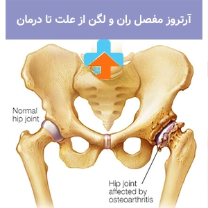 فیزیوتراپی می‌تواند نقش مؤثری در کاهش درد ناشی از آرتروز مفصل ران و بهبود حرکت بیمار داشته باشد.