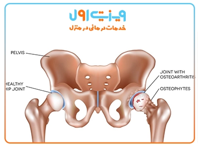 در آرتروز مفصل ران، آسیب به غضروف باعث ساییدگی استخوان‌ها و ایجاد درد و محدودیت حرکت می‌شود.