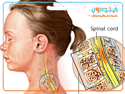تصویر نمایانگر میزان و سطح آسیب دیدگی نخاع در ناحیه گردنی.