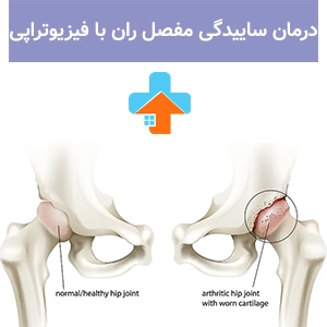فیزیوتراپی مفصل ران یکی از مؤثرترین روش‌های درمان غیرجراحی مفصل ران در افراد مبتلا به ساییدگی مفصل ران است.