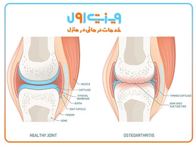 یکی از مهم‌ترین پاسخ‌ها به این سؤال که علت بروز استئوآرتریت یا ساییدگی مفصل ران چیست؟ افزایش سن و فرسودگی تدریجی غضروف مفصلی است.