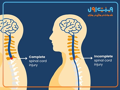 تصویری که علائم آسیب نخاعی شامل فلج یا ضعف در نواحی گردن یا کمر را نمایش می‌دهد.