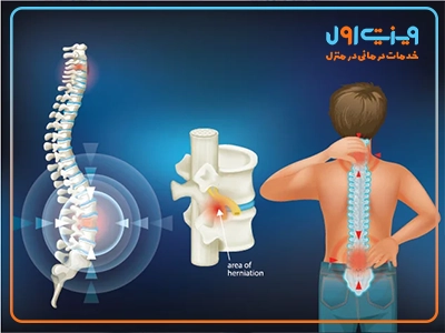 تصویری از آسیب نخاعی (spinal cord injury) که تاثیر آن بر سلول‌های عصبی و اعصاب نخاعی را نشان می‌دهد.